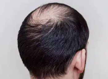 FUT Hair Transplant 