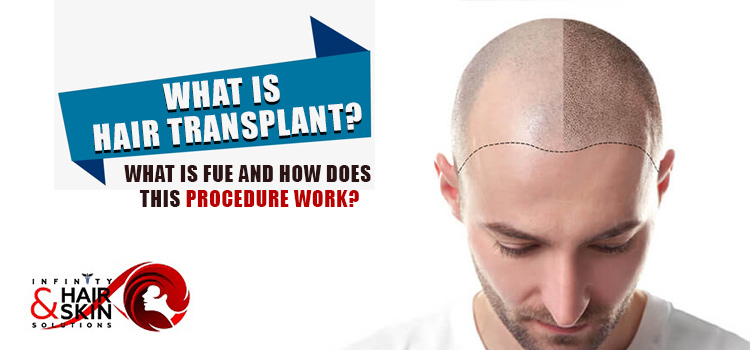 What is hair transplant? What is FUE and how does this procedure work?