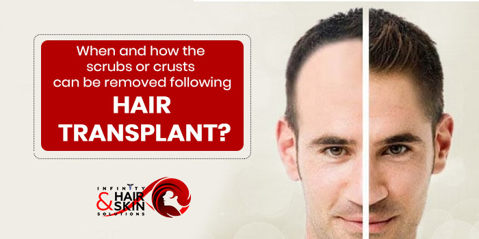 When and how the scrubs or crusts can be removed following hair transplant?