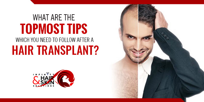 What are the topmost tips which you need to follow after a hair transplant