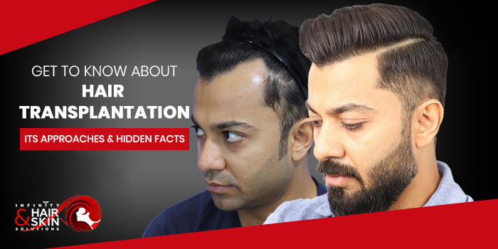 hair transplantation, its approaches and hidden facts 2021