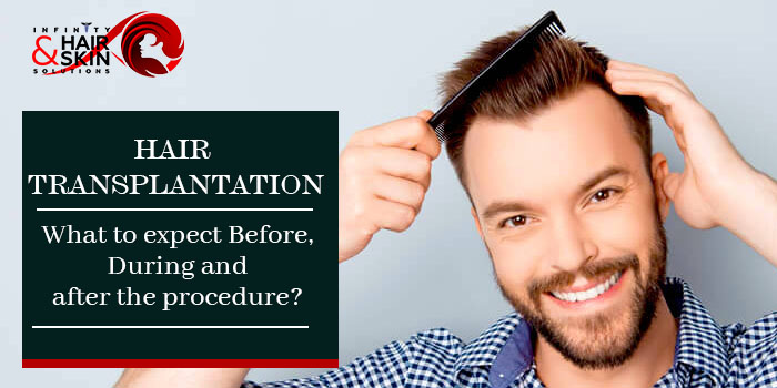 Hair transplantation What to expect Before, During and after the procedure