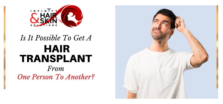 Is it possible to get a hair transplant from one person to another?