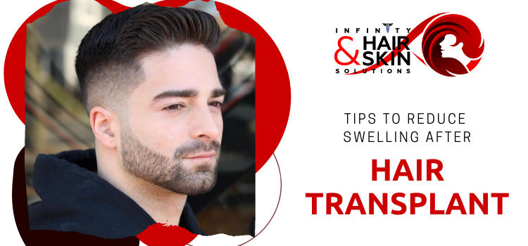 What is a hair transplant? What are the various types and their benefits?